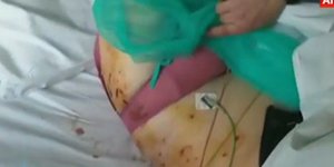 Η γυναίκα που την χτύπησε κεραυνός στην Ακρόπολη