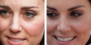 Η Κέιτ Μίντλετον πριν και μετά το botox