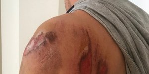 Με σοβαρές εκδορές αλλά και συντριπτικά κατάγματα ο αστυνομικός στο Αγρίνιο