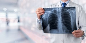 Γιατρός με ακτινογραφία πνεύμονα στα χέρια για θεραπεία του καρκίνου