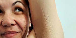 Γυναίκα δείχνει ραγάδες στο χέρι