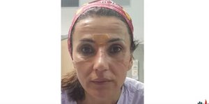 Κορωνοϊός: Γιατρός στην Ιταλία με παραμορφωμένο, από την μάσκα, πρόσωπο