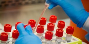 Εργαστηριακή ανάλυση δειγμάτων από ασθενείς της Covid-19 στις ΗΠΑ