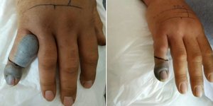 φίδι δάγκωμα οχιάς παραμορφωμένο χέρι