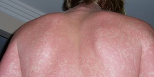 Δερματικά εξανθήματα