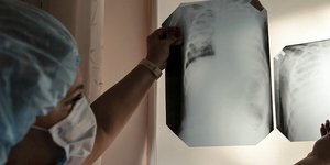 Γιατρός κοιτάζει ακτινογραφίες θώρακος 