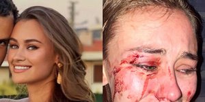 Η ουκρανή που υποστηρίζει ότι έπεσε θύμα ξυλοδαρμού στην Τουρκία