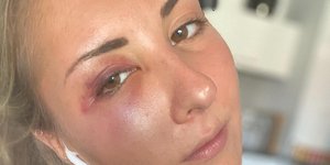 Με μελανιά στο μάτι η 22χρονη φοιτήτρια στο Στρασβούργο