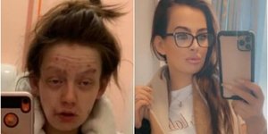 H απίστευτη αλλαγή νεαρής κοπέλας αφού έκοψε τις ναρκωτικές ουσίες