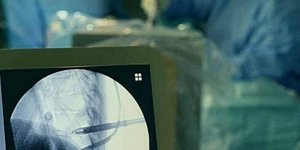 Για πρώτη φορά απόλυτα επιτυχημένη διαδερμική ενδοσκοπική δισκεκτομή