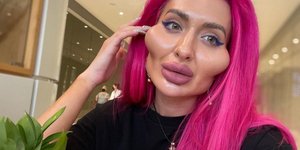 Το μοντέλο του Instagram από το Κίεβο με τα υπερβολικά μεγάλα μάγουλα