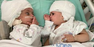 Τα σιαμαία κοριτσάκια μετά τον διαχωρισμό τους