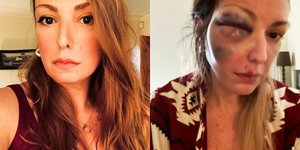 Η food blogger τόλμησε να δείξει την κακοποίηση που υπέστη από το σύντροφό της