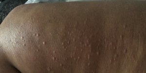 Δερματικά εξανθήματα όπως αυτό θα μπορούσε να είναι σύμπτωμα της Covid-19