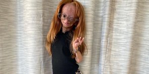 H 15χρονη Αντάλια που πέθανε από προγηρία