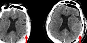 Για πρώτη φορά επιστήμονες κατέγραψαν την εγκεφαλική δραστηριότητα όταν πεθαίνουμε
