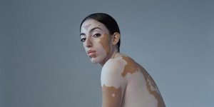 Το μοντέλο με τη λεύκη δείχνει το σώμα της όπως είναι/Φωτογραφία: Kristina Varaksina Photo/instagram