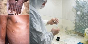 Συναγερμός για την ευλογιά των πιθήκων
