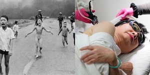 To «κορίτσι της ναπάλμ» υποβλήθηκε την Τρίτη στη τελευταία της θεραπεία για τις πληγές από τα εγκαύματα