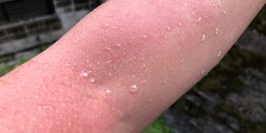 Οξεία κνίδωση με κόκκινο εξάνθημα και συμπτώματα φαγούρας στο δέρμα