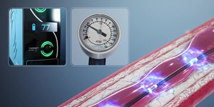Ενδοστεφανιαία λιθοτριψία: Σύγχρονη αντιμετώπιση στεφανιαίων βλαβών
