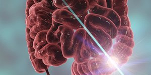 Καρκίνος παχέος εντέρου και ορθού: Οι σύγχρονες θεραπείες 