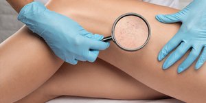 Αντιμετώπιση των ευρυαγγειών