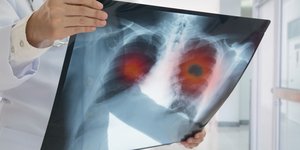 Γιατρός κρατά ακτινογραφία που ανιχνεύει καρκίνο 