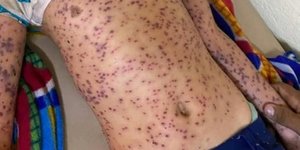Έξι νεκροί από τσιμπήματα μελισσών στη Νικαράγουα