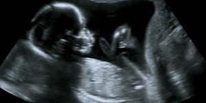 Έκαναν εγχείρηση στον εγκέφαλο αγέννητου μωρού που διαγνώστηκε με δυσπλασία της φλέβας του Γαληνού 