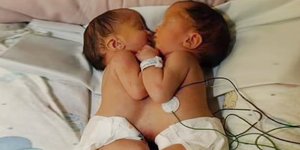 Οι δίδυμες σιαμαίες που χωρίστηκαν σε εγχείρηση πριν 20 χρόνια