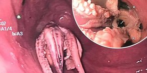 Χταπόδι σφηνώθηκε στον λαιμό ενός άνδρα στη Νότια Κορέα