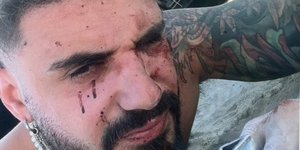 O Λιρόι Άλεξ έχασε την όραση από το ένα μάτι και τραυματίστηκε κατά την επίθεση της Χαμάς στο μουσικό φεστιβάλ στο νότιο Ισραήλ