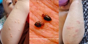 Κοριοί τσίμπησαν εκατοντάδες φορές νήπιο στη Βρετανία 