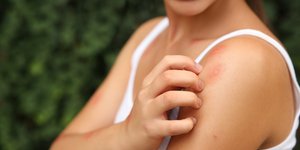 Για αυτούς τους 4 λόγους σας τσιμπάνε τα κουνούπια