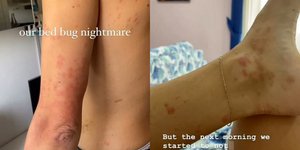 Γέμισαν σημάδια από κοριούς μετά από ένα νυχτερινό ταξίδι με τρένο από το Μόναχο στο Μιλάνο