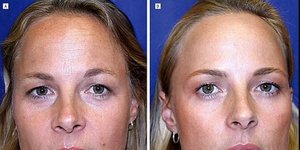 Αριστερά η δίδυμη που δεν έκανε, δεξιά η δίδυμη που έκανε botox