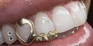 Κοσμήματα στα δόντια