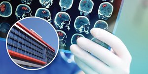 Τεχνητή νοημοσύνη για αντιμετώπιση εγκεφαλικών επεισοδίων στο Metropolitan Hospital