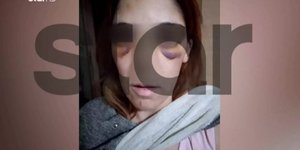 Εικόνα σοκ της 32χρονης που κακοποιήθηκε από τον σύζυγό της στο Άργος