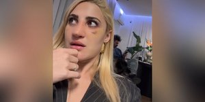 Η Ιωάννα Τούνη δείχνει το πρόσωπό της μετά την αισθητική επέμβαση και αποκαλύπτει το κόστος