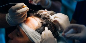 Μεταμόσχευση μαλλιών