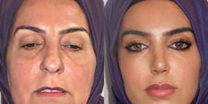 Το πριν και το μετά κατά την κλινική στην Τουρκία