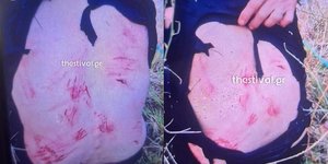 Τα σημάδια στο σώμα της 44χρονης από την επίθεση των σκύλων