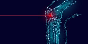 Πόνος στο γόνατο: Πότε χρειάζεται αρθροπλαστική;