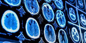 εξετάσεις για νευρολογική πάθηση