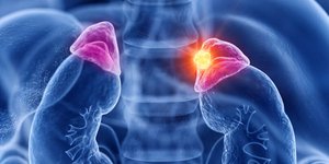 Όγκος στα επινεφρίδια