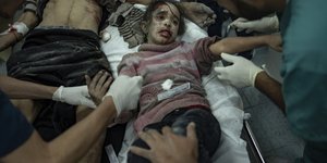 Τραυματισμένο κορίτσι σε νοσοκομείο της Γάζας