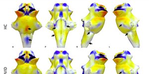Η βλάβη στο εγκεφαλικό στέλεχος υπεύθυνη για τα συμπτώματα του μακροχρόνιου Covid
