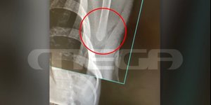 H ακτινογραφία που δείχνει πόσο βαθιά πήγε το κατσαβίδι στην πλάτη του 21χρονου